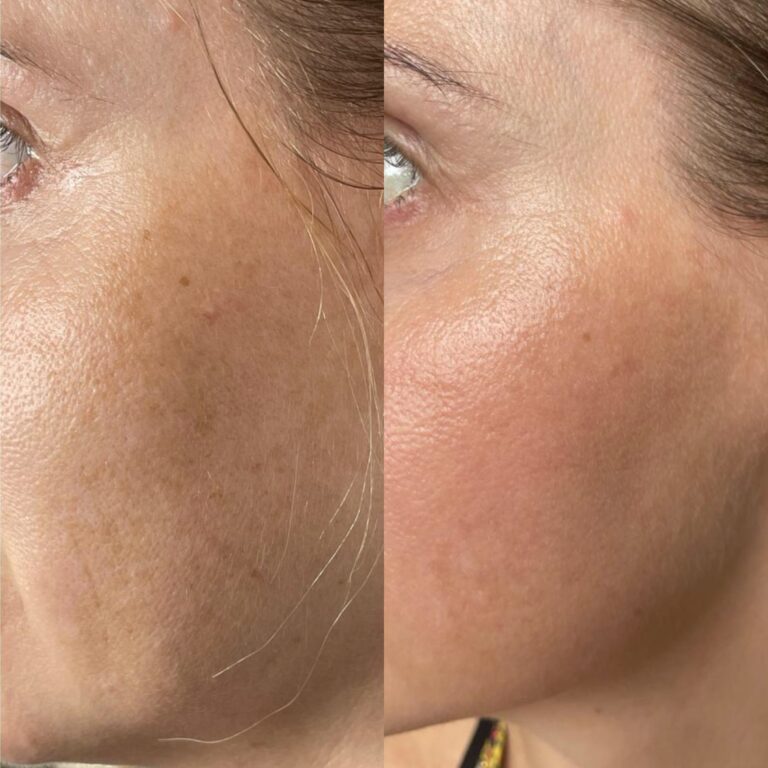 Laser tulowy – wiosna to ostatni dzwonek na efekt „baby face”